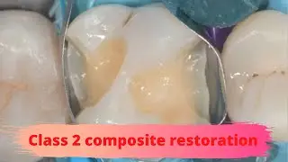 Class 2 composite restoration Step by Step