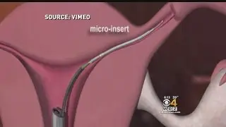 I-Team: FDA Issues 'Black Box' Warning On Birth Control Implant Essure