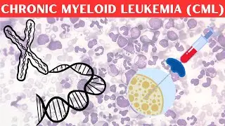 Chronic Myelogenous/Myeloid Leukemia (CML) - Signs & Symptoms, Pathophysiology, Diagnosis, Treatment