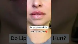 Do lip injections hurt? 💋 #lipfillers #lips #fillersinjection #fillers