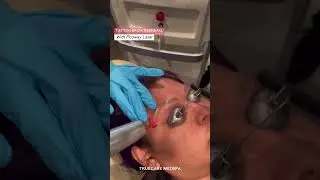 Tattoo Laser Removal for Eyebrows with PicoWay Laser