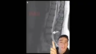 Surgery For Disc Herniations?