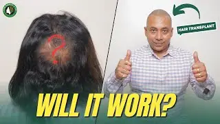 The Surprising Truth About Hair Transplant Nobody Tells You