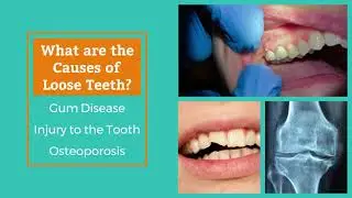 How to Fix Your Loose Teeth