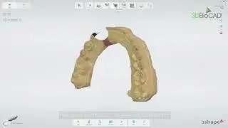3DBioCAD - TRIOS implant workflow