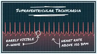SVT - SUPRAVENTRICULAR TACHYCARDIA - Arrhythmias - Causes, symptoms, ECG - Stable & Unstable Patient