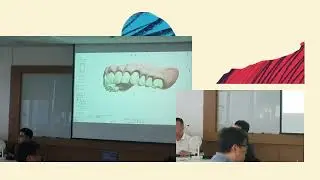 Ivotion Digital Denture