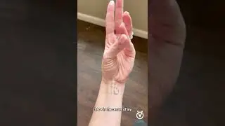 Do you have a palmaris longus? #handtherapy #occupationaltherapy