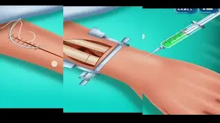 open reduction internal fixation of radius bone | plating procedure in radius arm bone|@catstory101