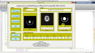 Medical Image Fusion on DICOM Images Using wavelet Transform and PCA Full Matlab Source Code