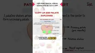 Cleft Lip and Palate Explained