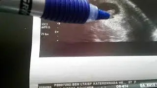 Pr&eacute;diction  sexe bb m&eacute;thode de ramzy