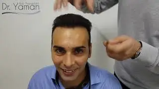 Dr Resul Yaman Hair Clinic - 3710 Grafts Result