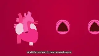 Heart valve disease