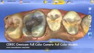 Find South Tulsa Porcelain Crowns | South Tulsa Dentist | 918-366-9500
