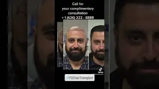 FUE Hair Transplant Before and After Best Fue Hair Transplant LA, Los Angeles, Beverly Hills