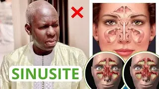 REMEDE SINUSITE DE A &agrave; Z SERIGNE SAMBA NDIAYE [FRAN&Ccedil;AIS]