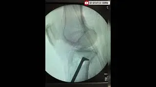 Depressed tibial fragment elevation technique- Schatzker type 2 tibial plateau fracture #orthopedics