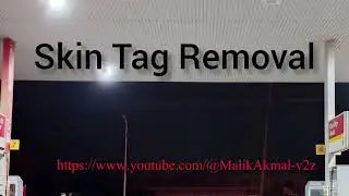 Skin Tag Removal With Radiofrequency | Quick & Safe Treatment  and safely work 