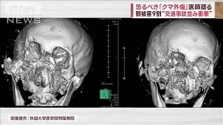 医師が語る恐るべき「クマ外傷」　頭被害9割“交通事故並み衝撃”(2023年11月10日)