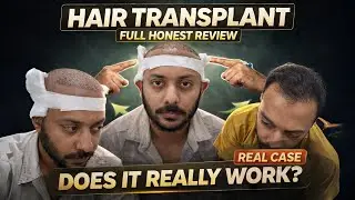 Hair transplant in indore | Best Results & Cost of Hair Transplant in indore