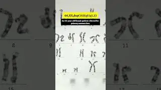 🔬 Abnormal Karyotype | Part 6 #biology #shorts #genetics