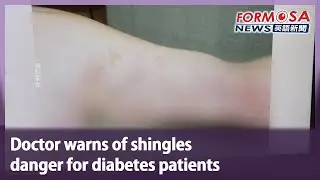 Doctor warns of shingles danger for diabetes patients｜Taiwan News