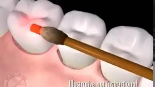 Staten Island Periodontist Shares FDA Cleared Laser Periodontal Surgery for Gum Disease