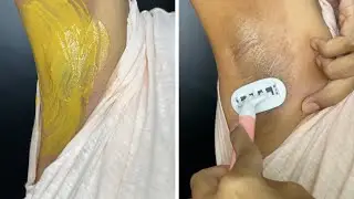 Как избавиться от темных подмышек за 3 простых шага