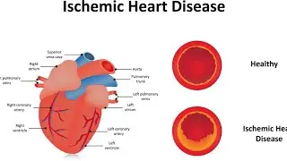 باطنية م5 ك1 | مرحلة ثالثة تخدير | Ischemic Heart Diseases