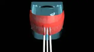 Disinfection of all 32 Parodonts with Plasma