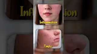 🚨 Can B12 Injections Cause Pimples? 🤔 #B12Injection #AcneAlert #PimpleBreakout #SkinTruth