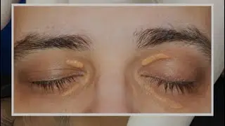cholesterol deposits on eyelids removal |