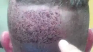 ARTAS Hair Transplant Procedure Day 2 | Charles Medical Group