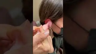 Remove Ear Wax Earwax Being Removed , Safely Remove Earwax at Home #short #earwax #earwaxremoval