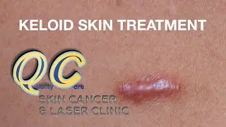 Keloid Scar Treatment | QC Skin & Laser Clinic
