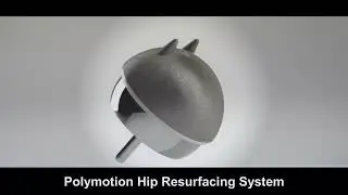 Polymotion Hip Resurfacing System by JointMedica Inc.
