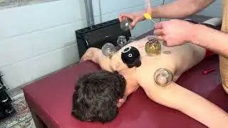 fire therapy#firetherapy #cuppingtherapy #cuppingmassage #relaxing 