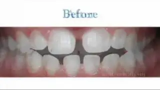 Invisalign Teen in Yuba City, CA with Dr. Thomas A. Iverson, Orthodontist