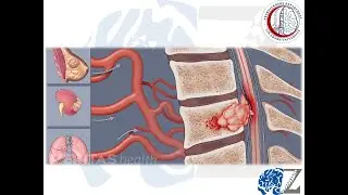 Spinal Tumours (3):  Epidural Metastases (2)  أورام العمود الفقري الخبيثة المنتشرة