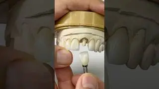 Signature crowns for Dr. Erik Svans in Arizona