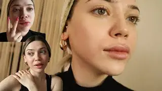 Green Peel Yaptırdım (İzlemeden Yaptırmayın) l Günlük Vlog