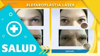 Blefaroplast&iacute;a L&aacute;ser, rejuvenece tu mirada sin cirug&iacute;as | Un Nuevo D&iacute;a | Telemundo