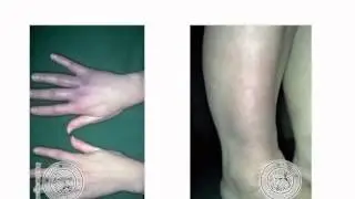 Klinikiniai Laimo ligos aspektai ir gydymas