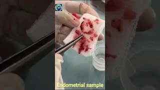 DILATION AND CURETTAGE (D and C) procedure