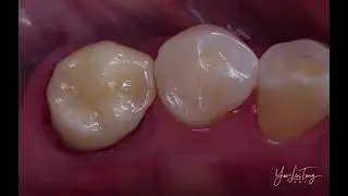 Cerasmart & Optiglaze Color in 5 minutes