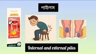Pilen forte drops|medisynth pilen forte|piles forte drop review| pilen forte usage|piles treatment 