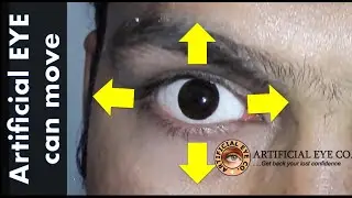Can artificial eye have movement when I see right or left ?