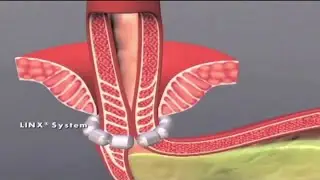 The heartburn medication alternatives suggested by doctors