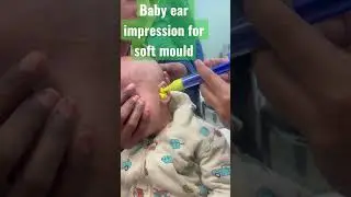 Baby Ear impression for soft mould || Congenital Hearing loss ||